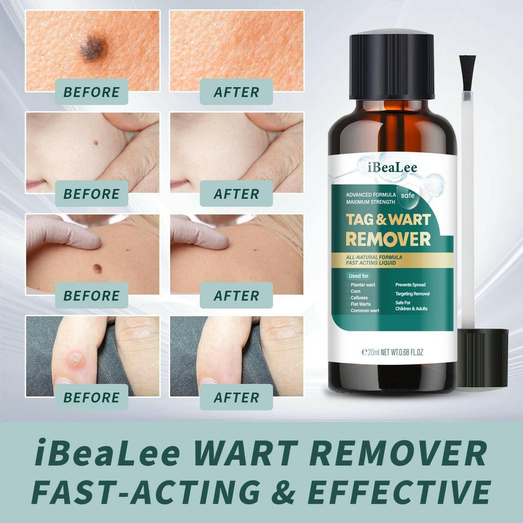 ELEFOCUS Wart Remover Liquid - 12% Wart Liquid with Salicylic Acid  Fast Acting