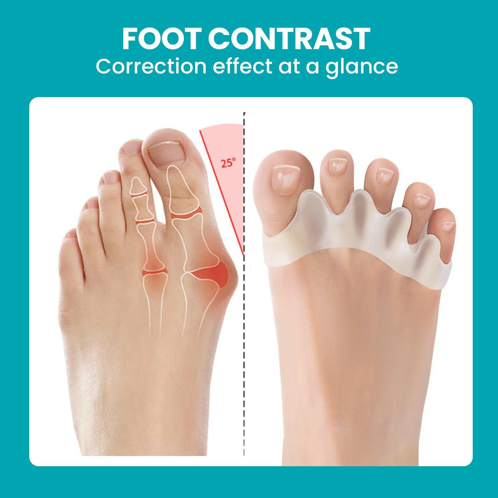 8 Pack Toe Separators for Correct Bunions - Promifun Toe Spacers for Women and