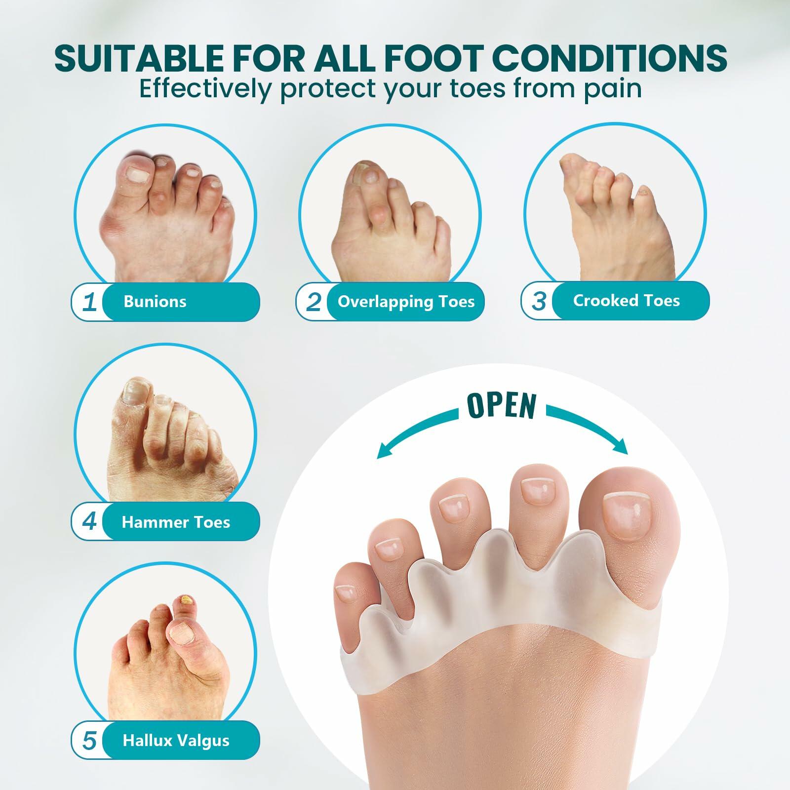 8 Pack Toe Separators for Correct Bunions - Promifun Toe Spacers for Women and
